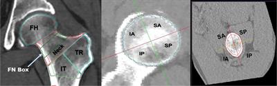 Differences in Hip Geometry Between Female Subjects With and Without Acute Hip Fracture: A Cross-Sectional Case-Control Study